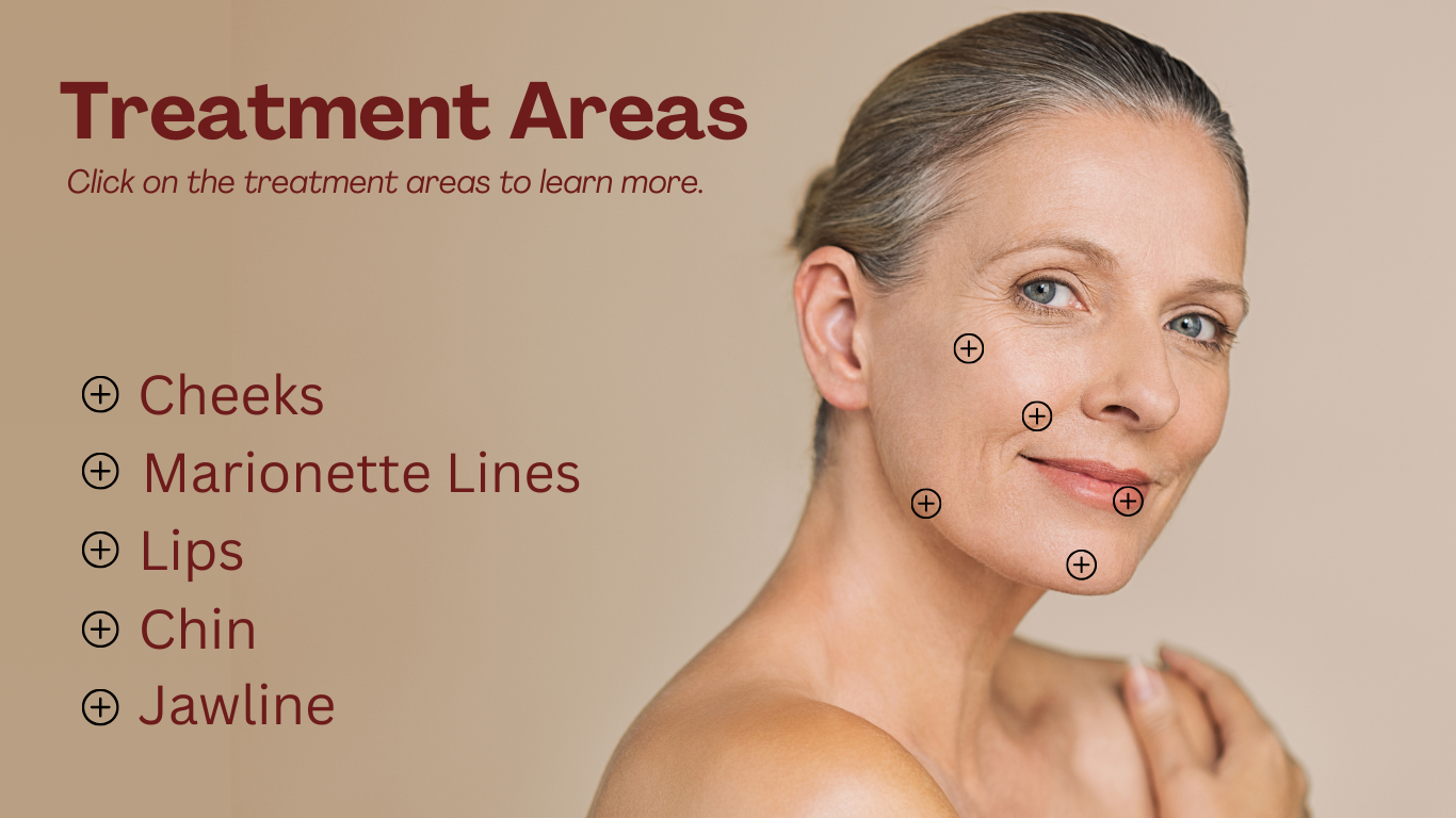 Juvéderm Treatment Areas
